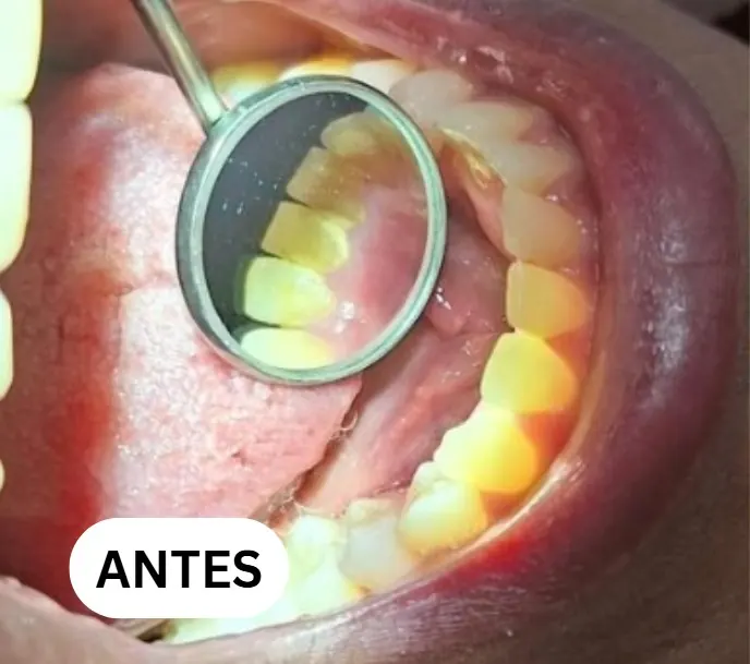Caso clínico 2 atendido pelo Dr. Douglas: fotografia intrabucal antes e depois do tratamento — antes