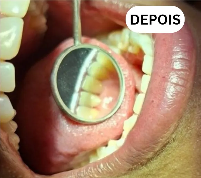 Caso clínico 2 atendido pelo Dr. Douglas: fotografia intrabucal antes e depois do tratamento — depois
