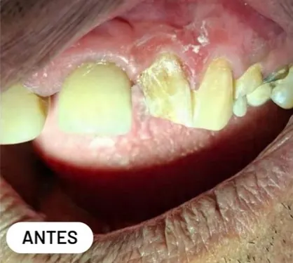 Caso clínico 4 atendido pelo Dr. Douglas: fotografia intrabucal antes e depois do tratamento — antes