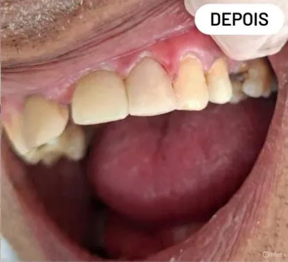 Caso clínico 4 atendido pelo Dr. Douglas: fotografia intrabucal antes e depois do tratamento — depois