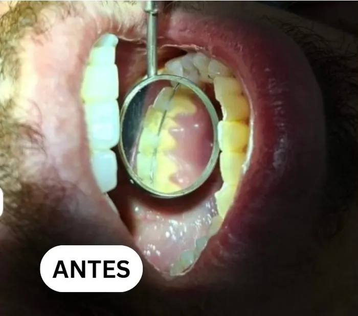 Caso clínico 1 atendido pelo Dr. Douglas: fotografia intrabucal antes e depois do tratamento — antes