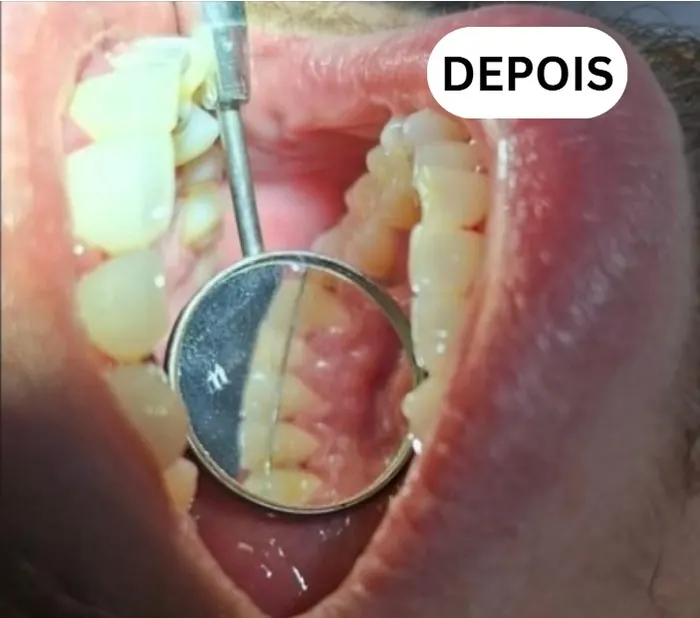 Caso clínico 1 atendido pelo Dr. Douglas: fotografia intrabucal antes e depois do tratamento — depois
