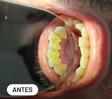 Caso clínico 3 atendido pelo Dr. Douglas: fotografia intrabucal antes e depois do tratamento — antes