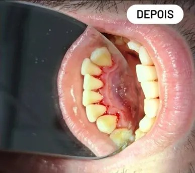 Caso clínico 3 atendido pelo Dr. Douglas: fotografia intrabucal antes e depois do tratamento — depois