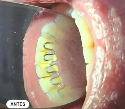 Caso clínico 5 atendido pelo Dr. Douglas: fotografia intrabucal antes e depois do tratamento — antes