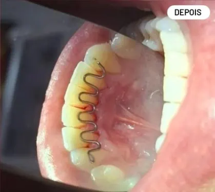 Caso clínico 5 atendido pelo Dr. Douglas: fotografia intrabucal antes e depois do tratamento — depois