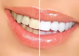 Comparação de meio sorriso antes e depois de clareamento dental