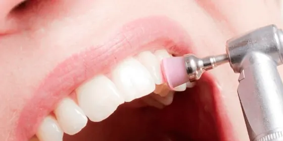 Profilaxia dental sendo feita com taça de borracha sobre os dentes