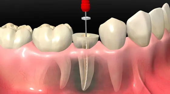Ilustração em 3D de um canal radicular sendo tratado com lima endodôntica